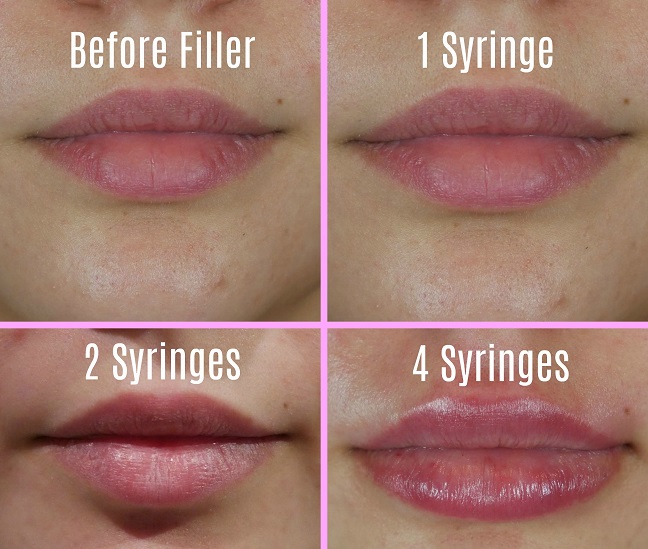 Lip fillers1