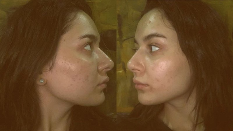 ACNE HANIA