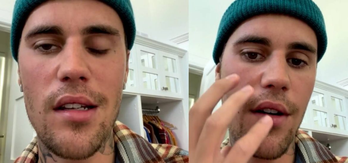 Important Watch It! – Justin Bieber Suffering From Partial Face Paralysis